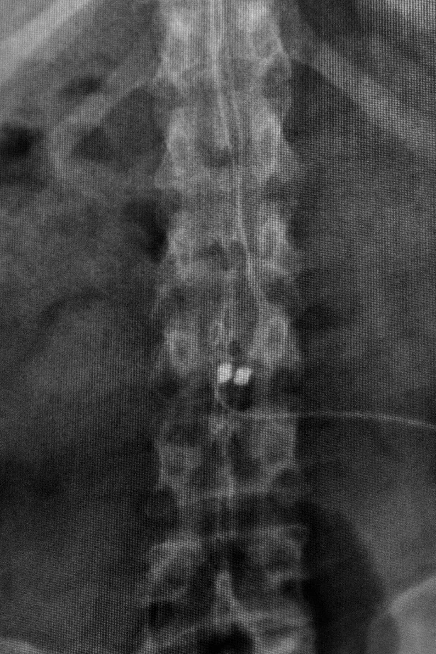 An X-Ray that shows my spinal stimulator leads
