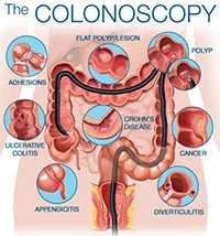 Colonosopy.jpg