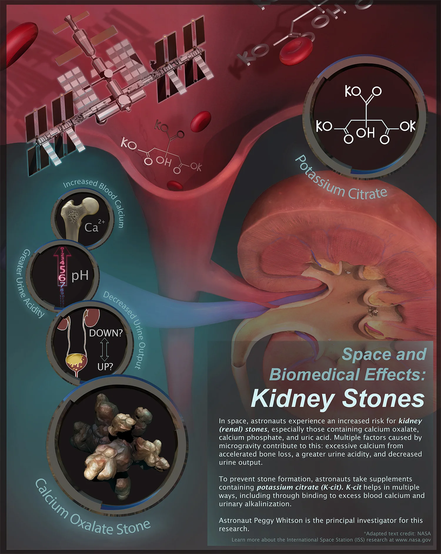 Space and Biomedical Effects- Kidney Stones