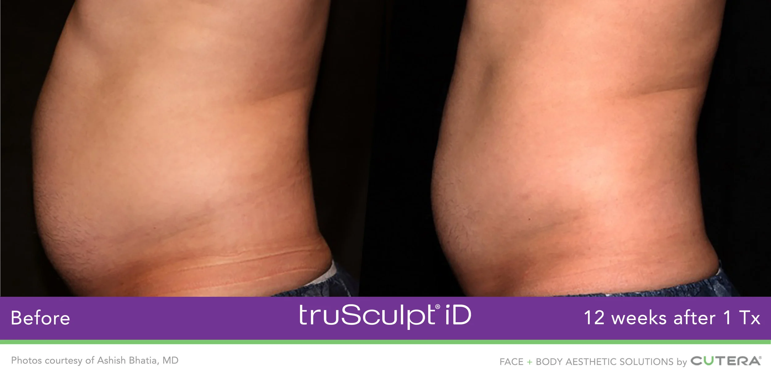 truSculpt-iD-B&A-side view of male abdomen.jpg
