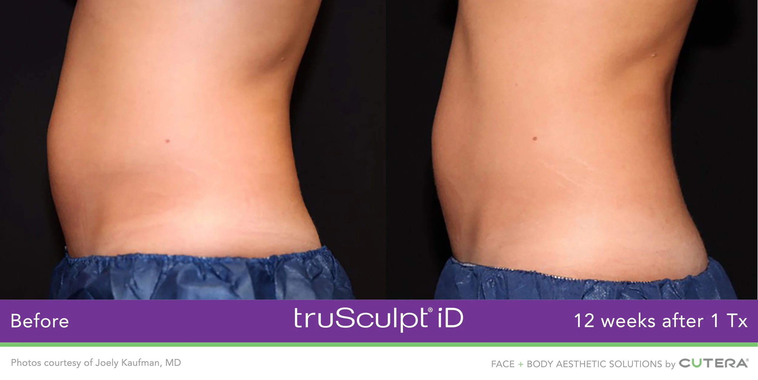 truSculpt-iD-B&A-side view of female abdomen.jpg