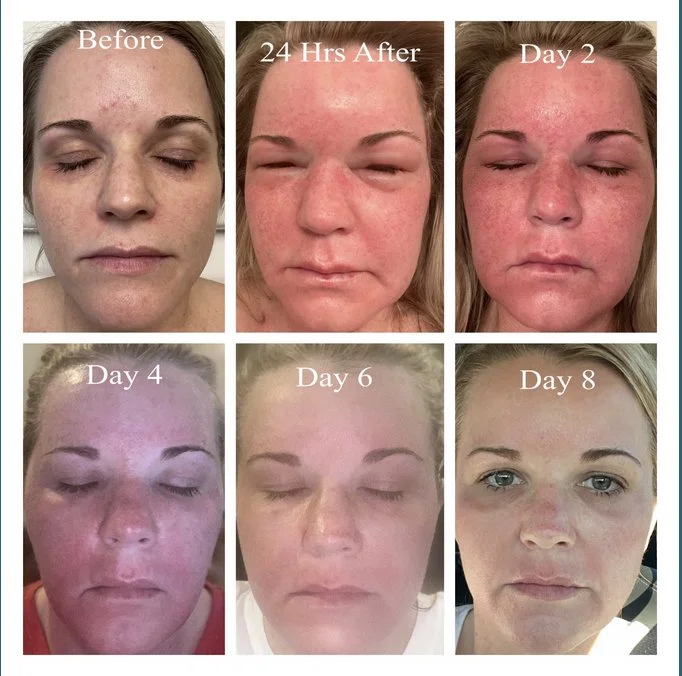 Halo BBL PROMO Vitality Kauai halo-bbl-promo-vitality-kauai