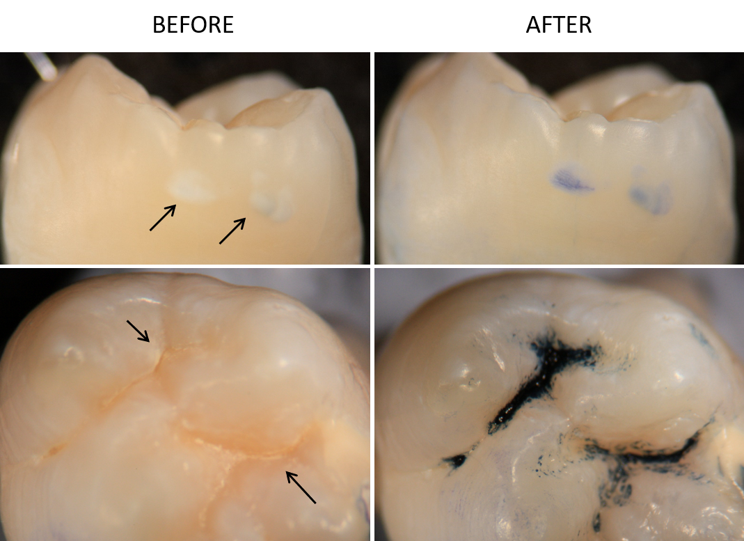 Areas of early caries on human teeth before and after exposure to BlueCheck. Arrows indicate regions of early decay.