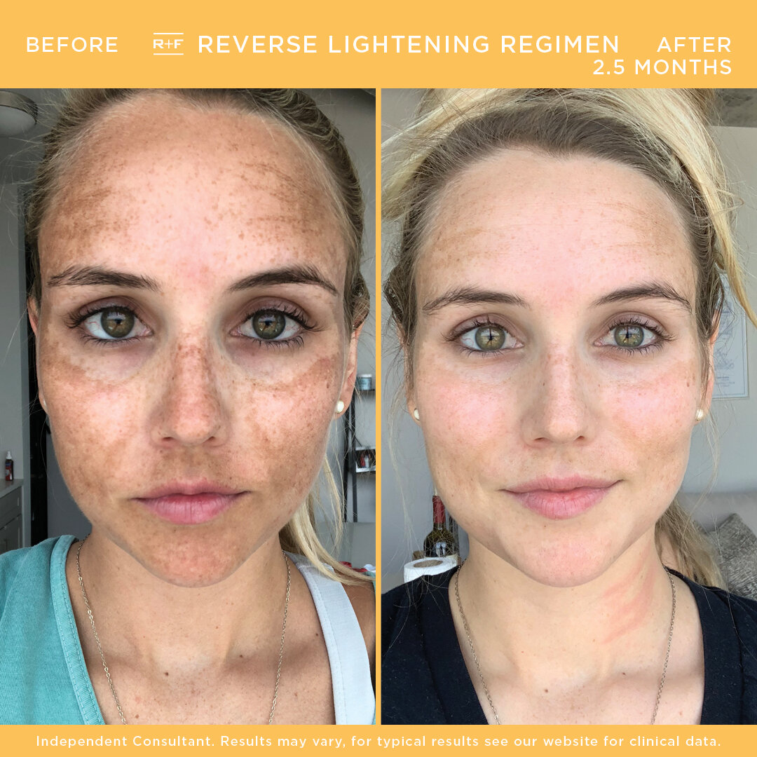 REVERSE LIGHTENING B&A - Kaitlyn .jpg