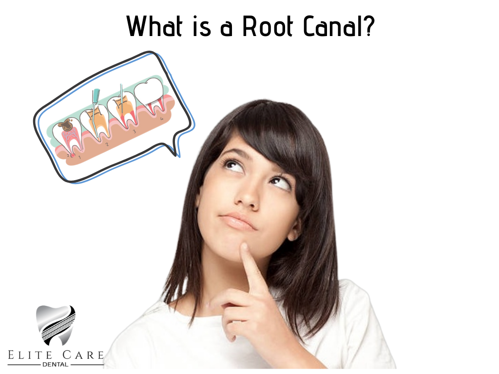 What Is A Root Canal Elite Care Dental