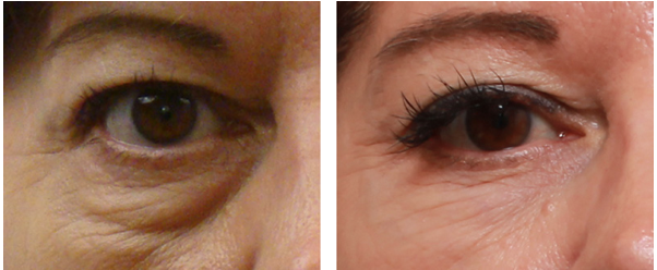 Nano needling with E. Crustaceum Naturally Occurring Marine Algae serum with