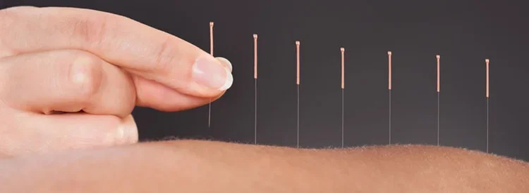 Acupuncture for Osteoarthritis