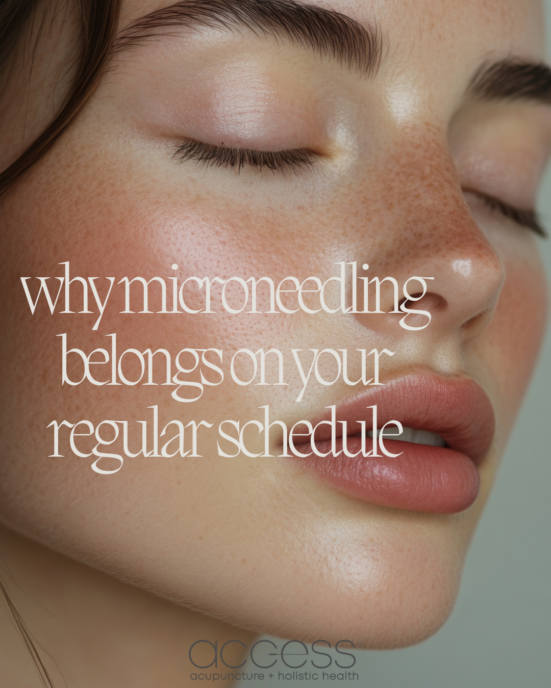 why microneedling needs to be a part of your skin routine