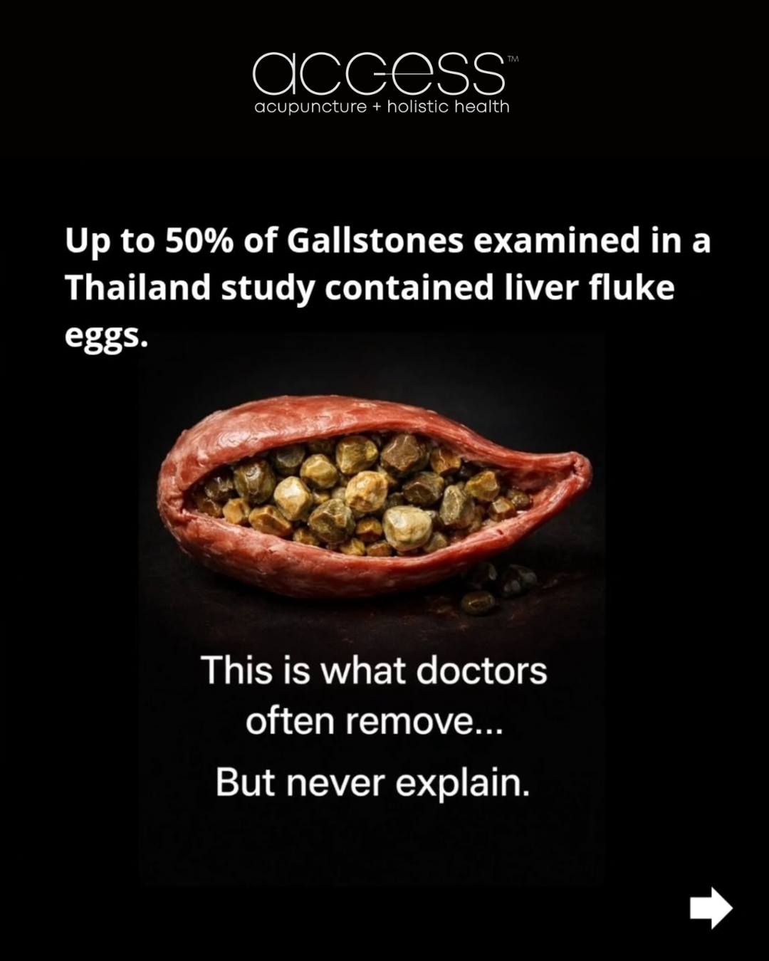Gallbladder Stones = defense mechanism, not malfunction.