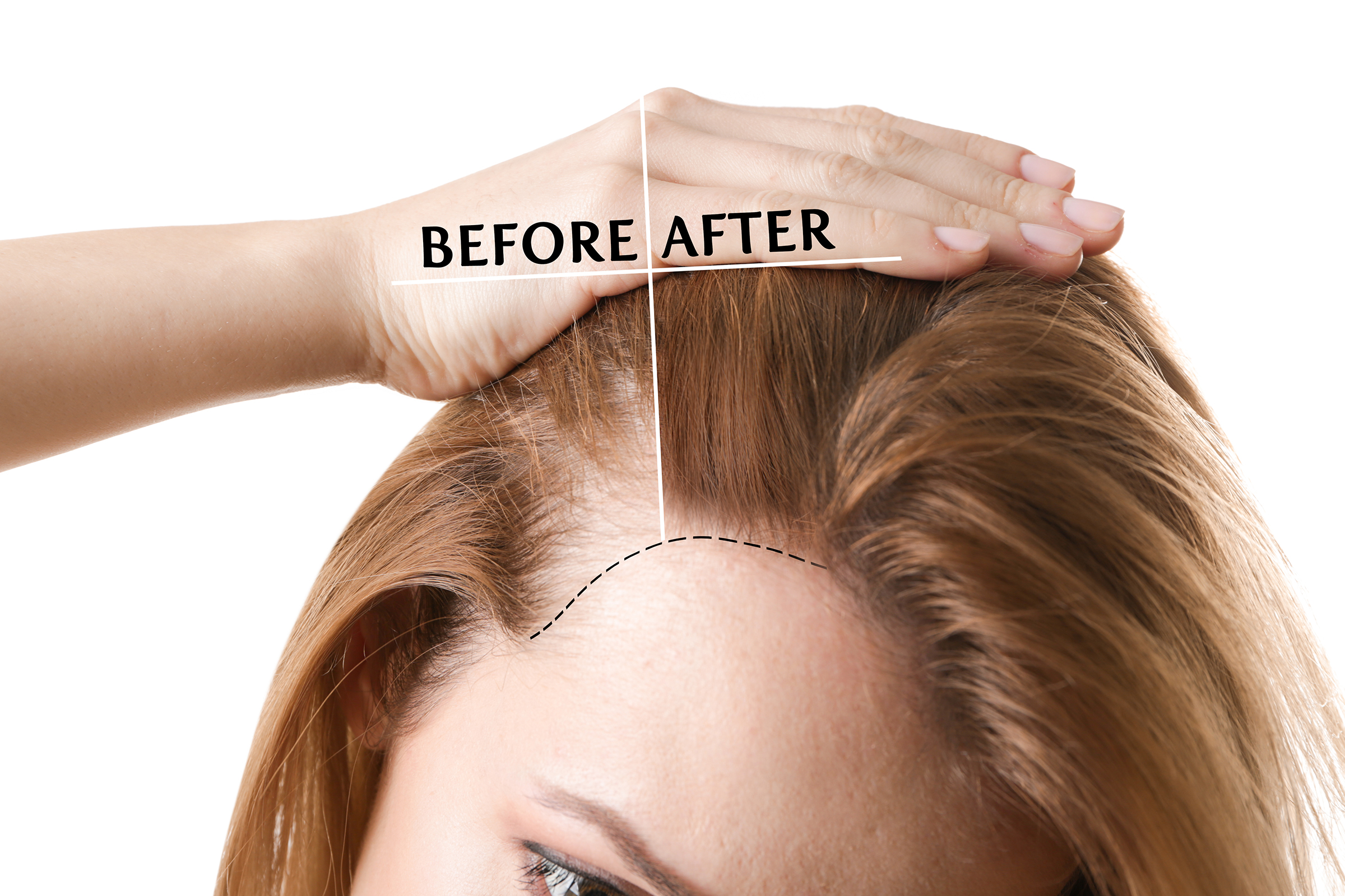 PRP Hair Restoration — Columbia Shores Regenerative Health