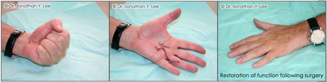 Figure 5: Restoration of hand function following surgery