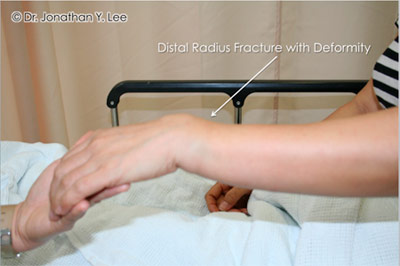 Figure 2: Distal Radius fracture with deformity.