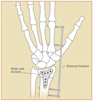Figure 5: Distal Radius Fractures – External and Internal Fixation