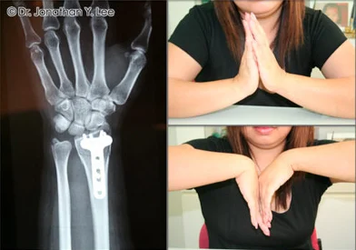 Figure 6: Internal fixation of distal radius fractures with plates and screws can avoid prolonged immobilisation in a case, and allow early movement and physical therapy