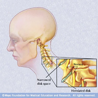 cervical-spondylosis.jpg