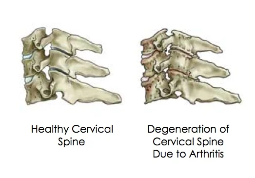Cervical-Spondylosis-1.jpg