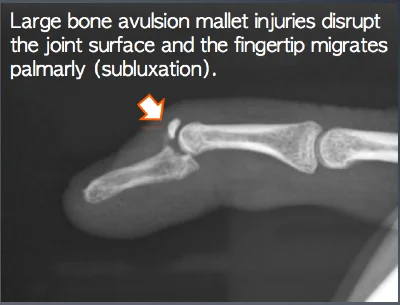 Mallet Finger injuries with large avulsion fractures are best treated with surgery.