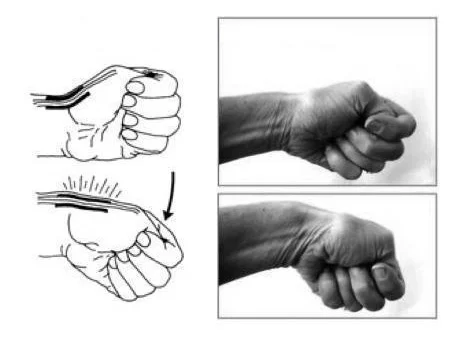 Symptoms of Mommy Thumb (De Quervain’s Tendonitis) - Dr. Jonathan Lee ...