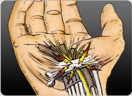 Compression of the Median Nerve under the Transverse Carpal Ligament (Carpal Tunnel)