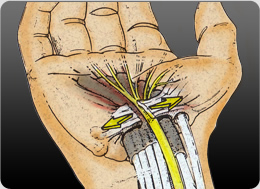 The goal of Carpal Tunnel Release surgery is to divide the Transverse Carpal Ligament and relieve the pressure on the Median Nerve.