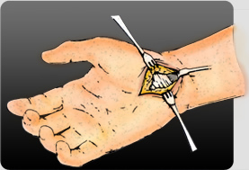Traditional Carpal Tunnel Release Surgery requires a long incision across the pressure bearing area of the palm