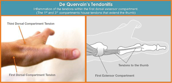 de quervain tenosynovitis compartment