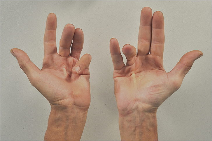 DUPUYTREN’S DISEASE filter.jpg