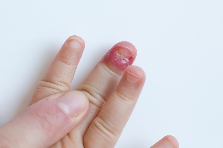 Hand Infections Dr Jonathan Lee Yi Liang Hand Infections Dr Jonathan Lee Yi Liang