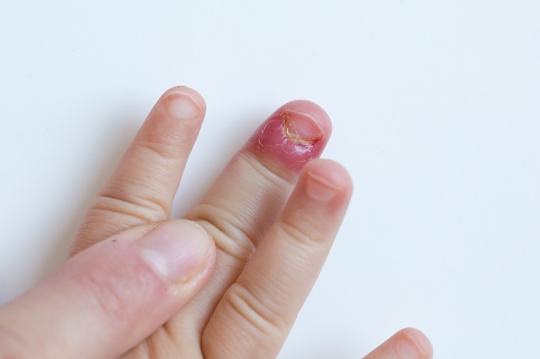 Nail Bed Injury: Healing Time & Treatments