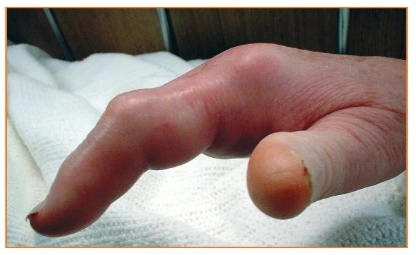 SEPTIC ARTHRITIS.jpg