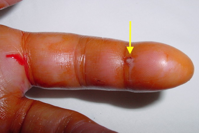 Close-up of the red and inflamed thumb in an 84 year old male patient due  to an abscess (bacterial infection) in the pulp space of the finger. This  le Stock Photo -