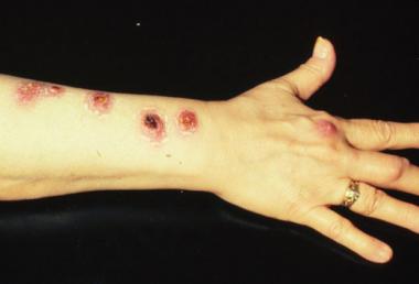 ATYPICAL MYCOBACTERIAL INFECTIONS .jpg