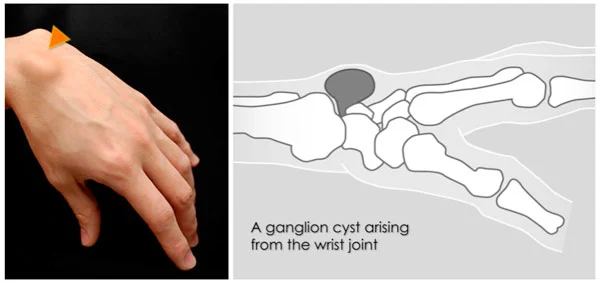 Figure 1: A common location to have a ganglion cyst is on the back of the wrist.