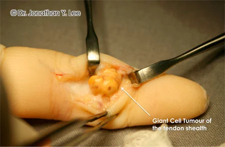 Figure 4: Giant Cell Tendon Sheath Tumour of the finger.