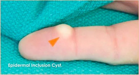 Figure 5: Epidermal inclusion cyst of the finger