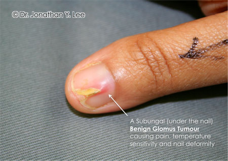 Figure 6: Glomus Tumour underneath the fingernail.