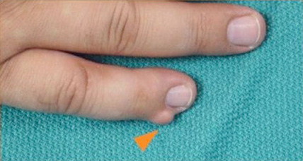 Figure 7: Fibroma of the little finger