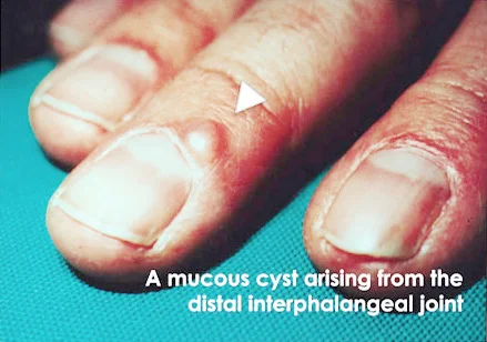 Figure 3: A mucous cyst is a ganglion cyst that arises from the small joints of the finger.
