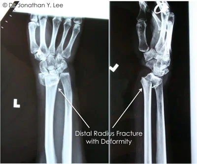 Figure 3 showing distal radius fracture with deformity