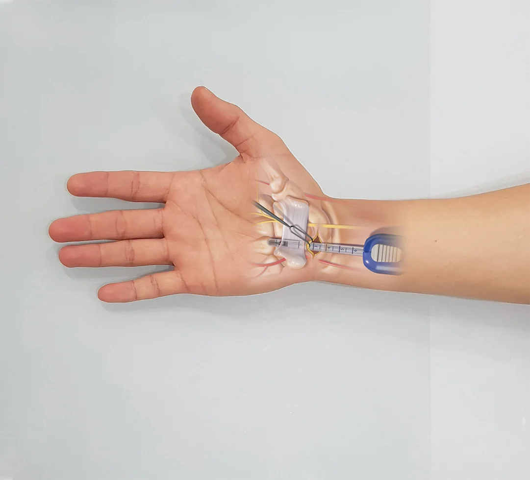 Illustration of endoscopic Carpal Tunnel Syndrome treatment