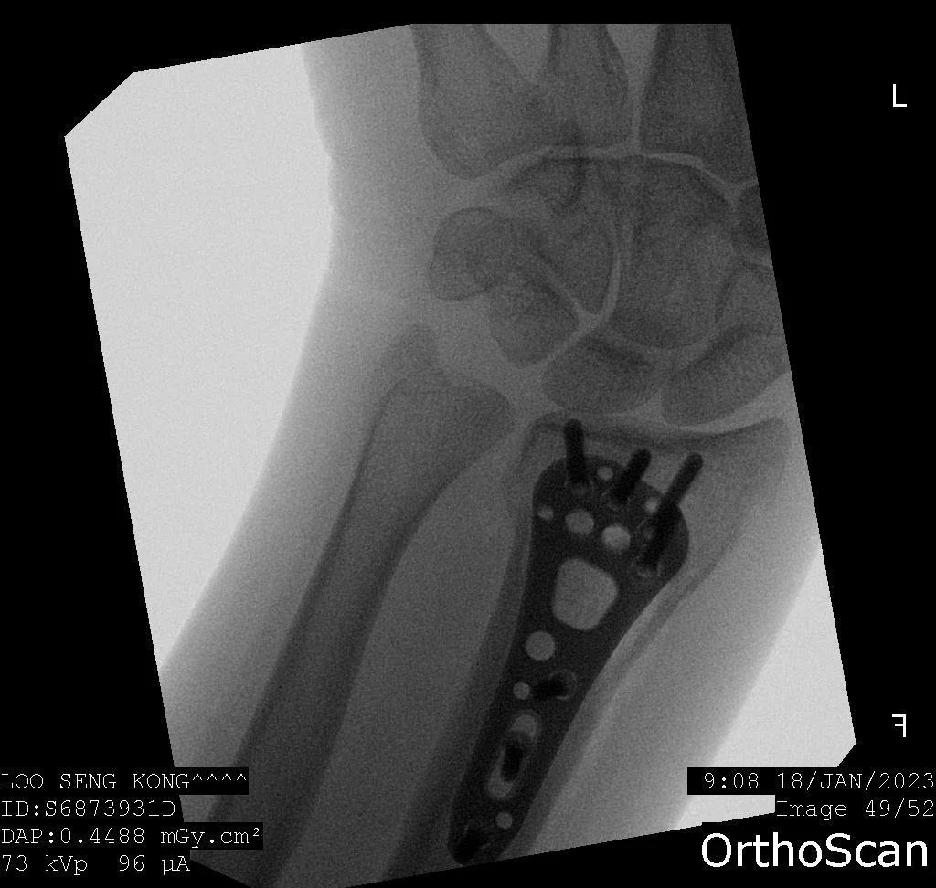 distal-radius-fracture-xray-example.jpg