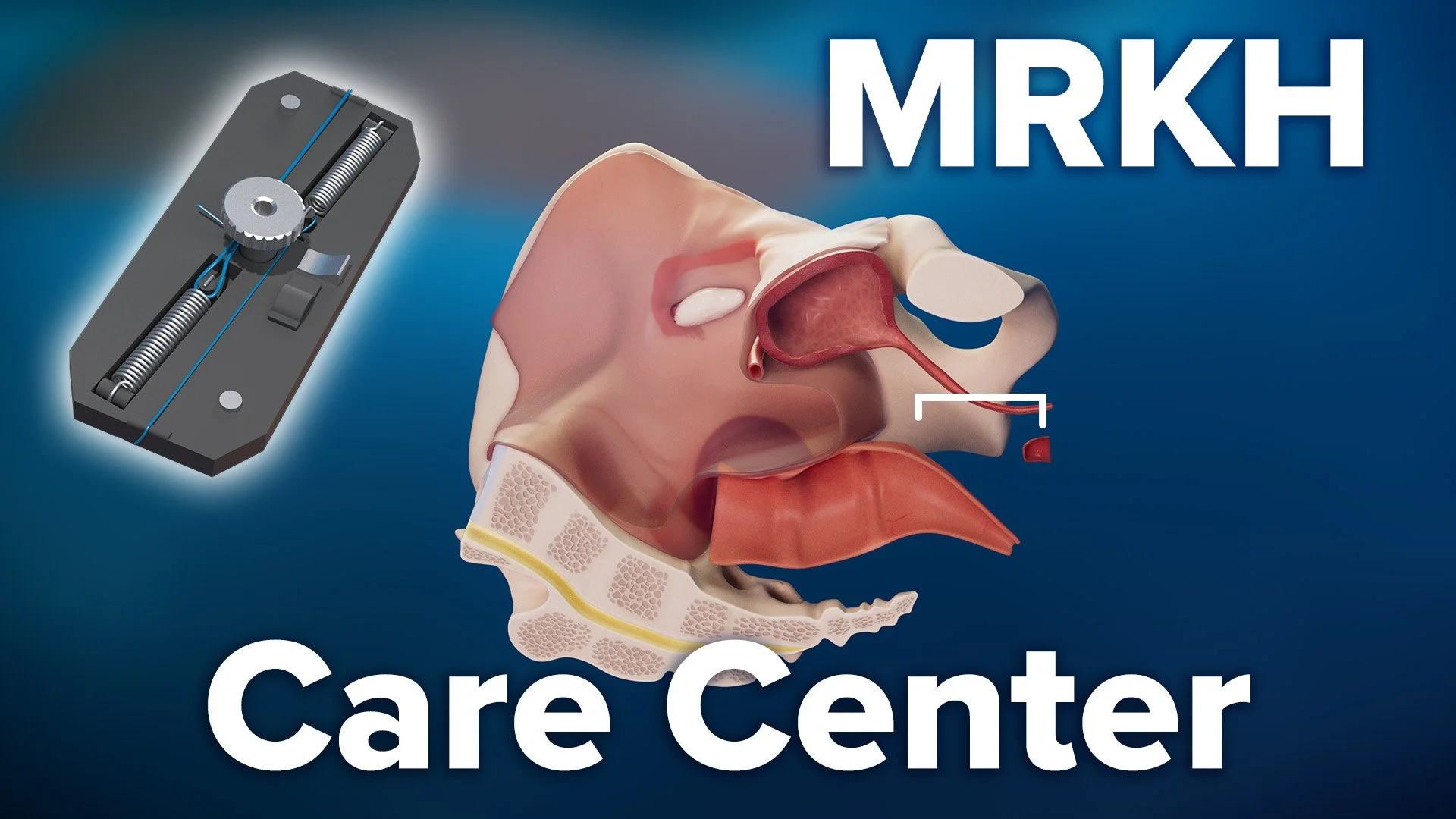 MRKH Care Center | Cincinnati Children's
