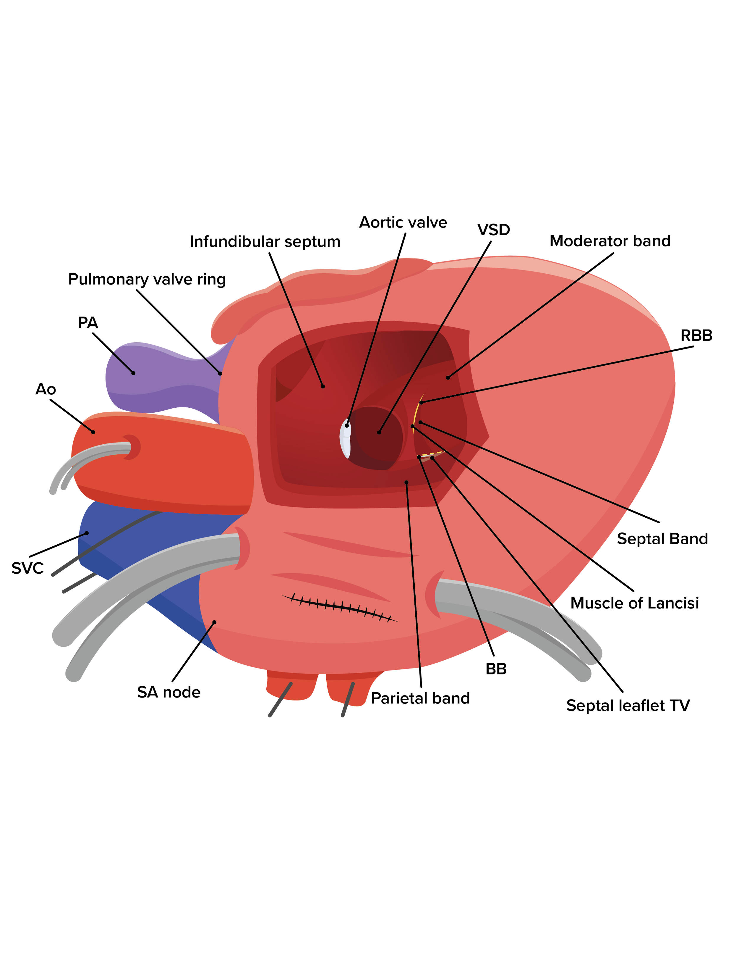 VSD_Anterior_03.png