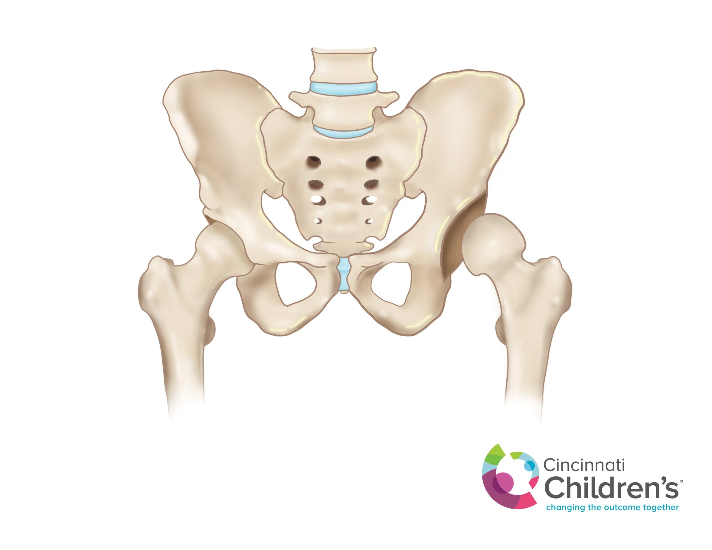 Severe Dysplasia