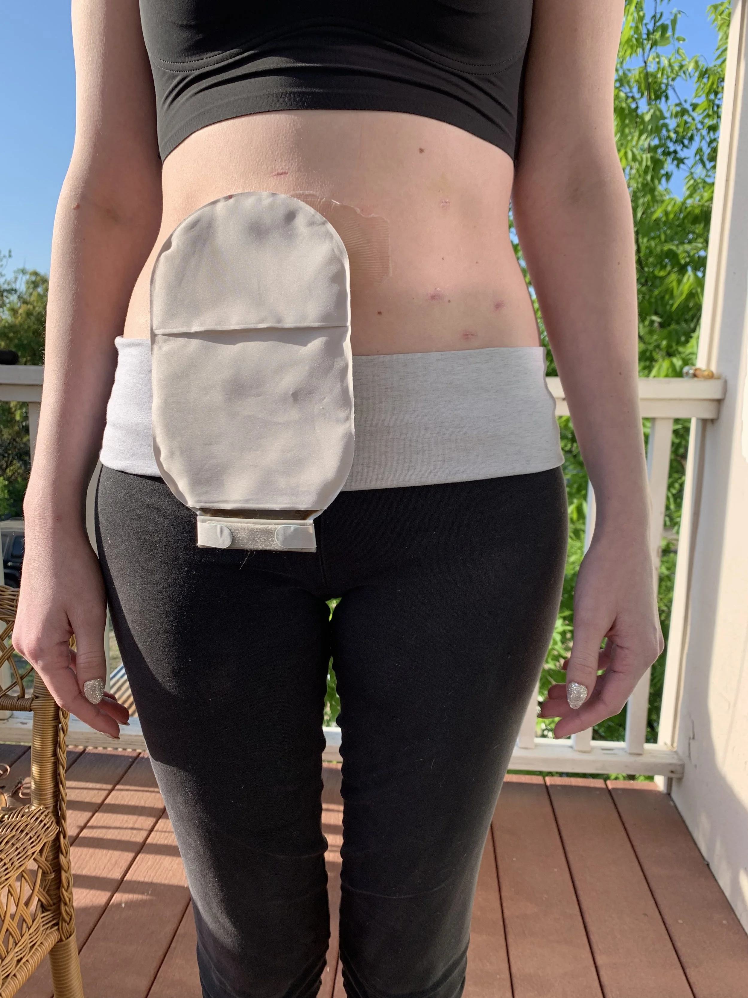 The Ileostomy Tales: Life As an Ostomate