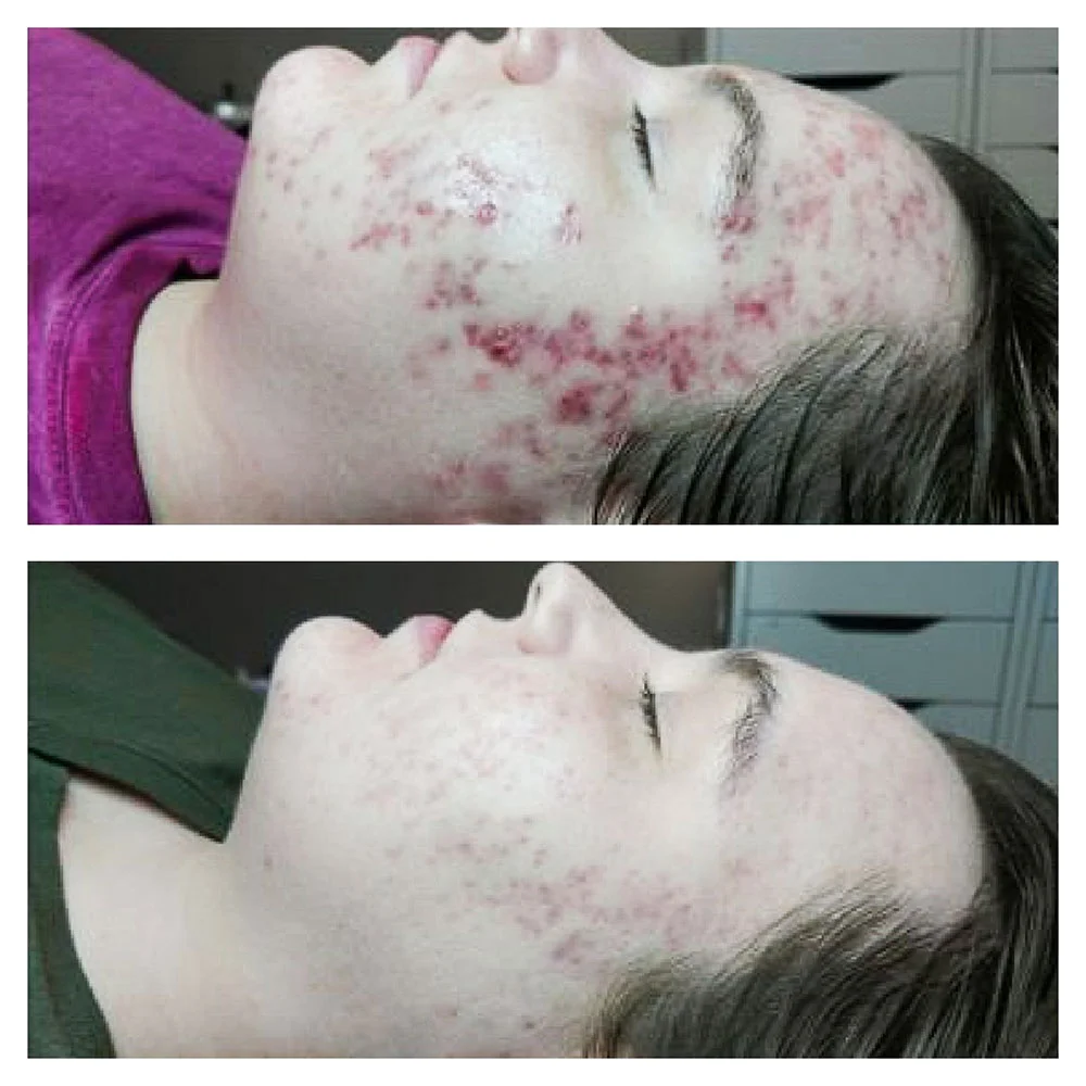 Acne treatment result after 8 weeks