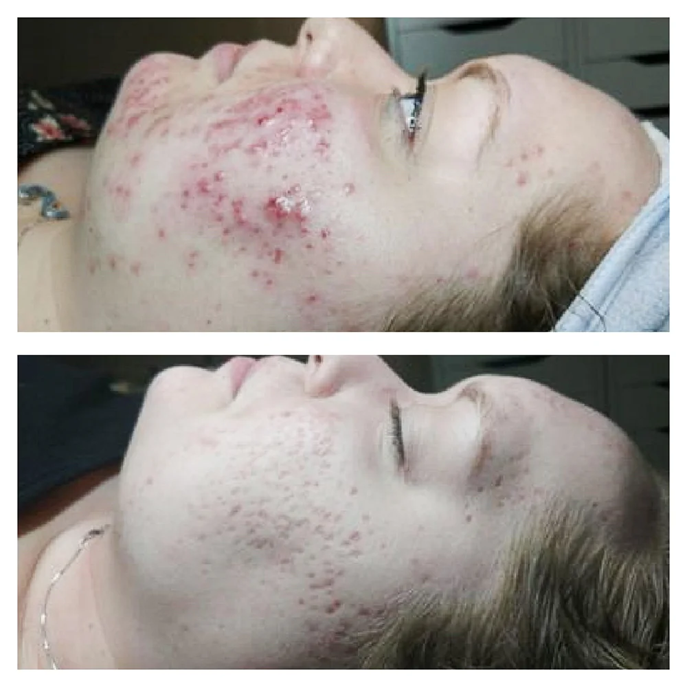 Acne treatment result after 8 weeks