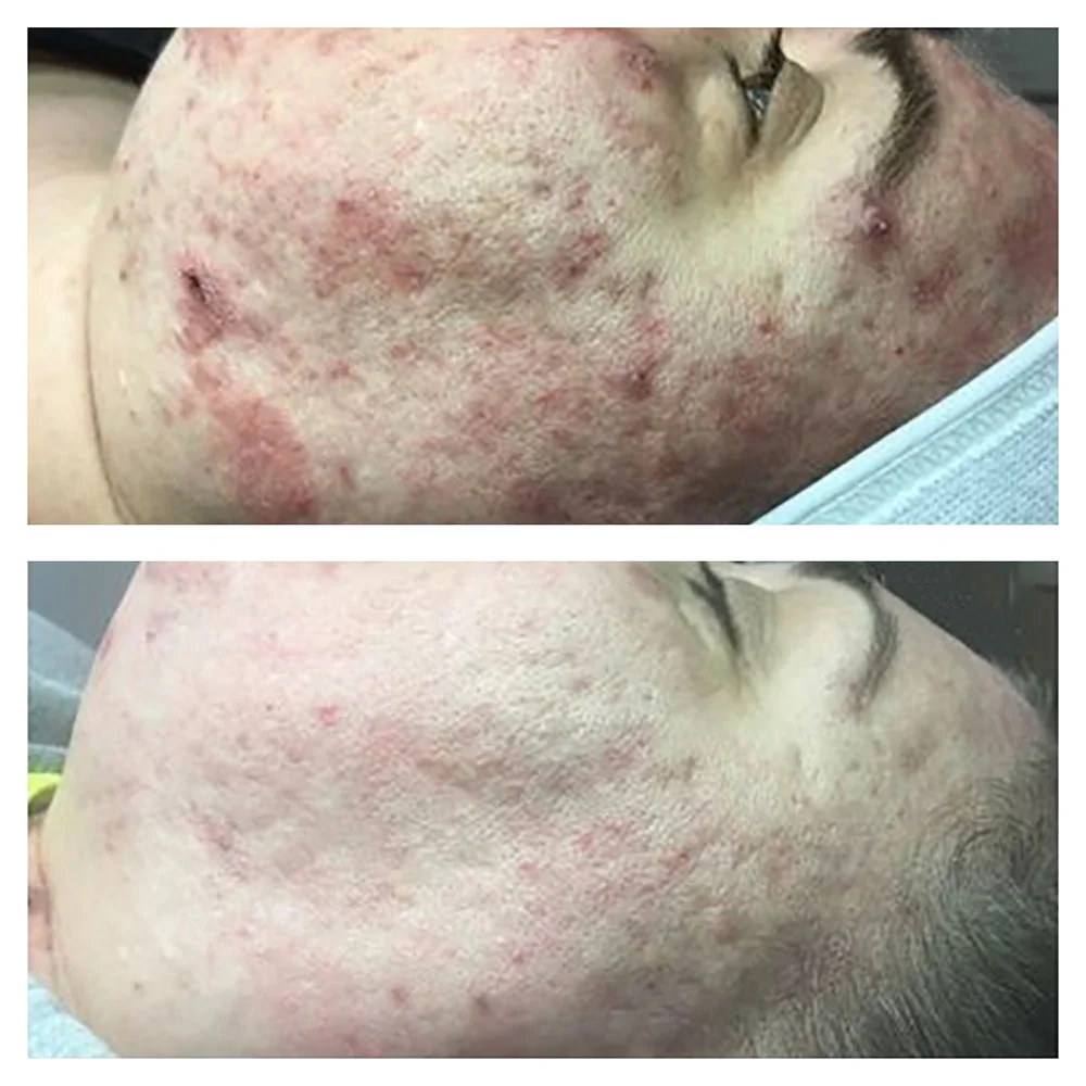 Acne treatment result after 8 weeks