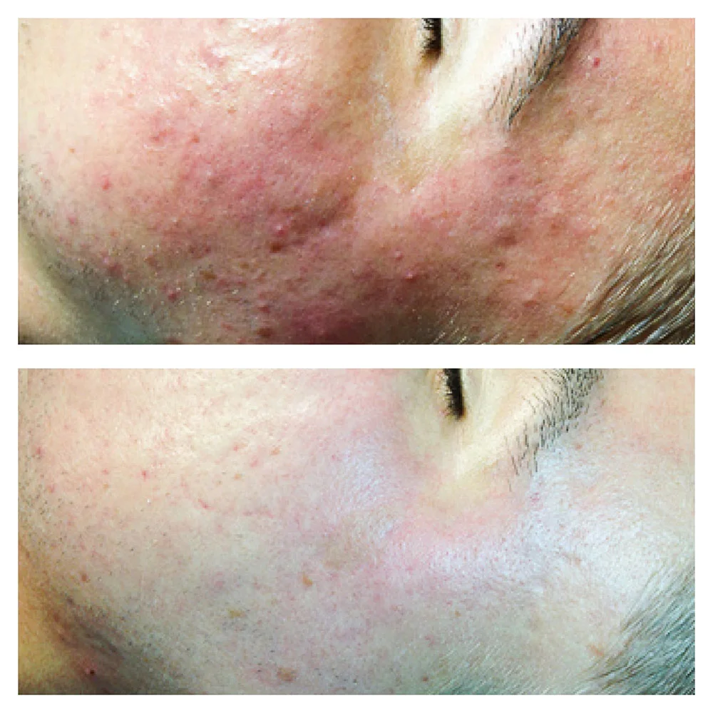 Acne treatment result after 6 weeks