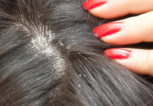 dandruff.jpg